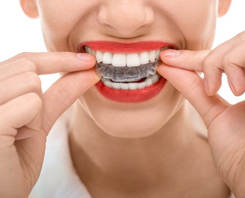 حامية الأسنان الليلية في الرياض 3 حامية الأسنان الليلية في السعودية
