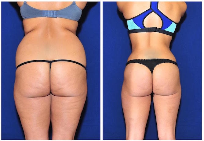 تقنية النحت البارد في الرياض 1 butt augmentation before and after