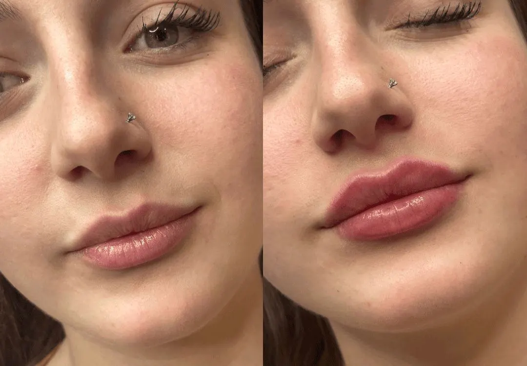 فيلر الكالسيوم قبل وبعد