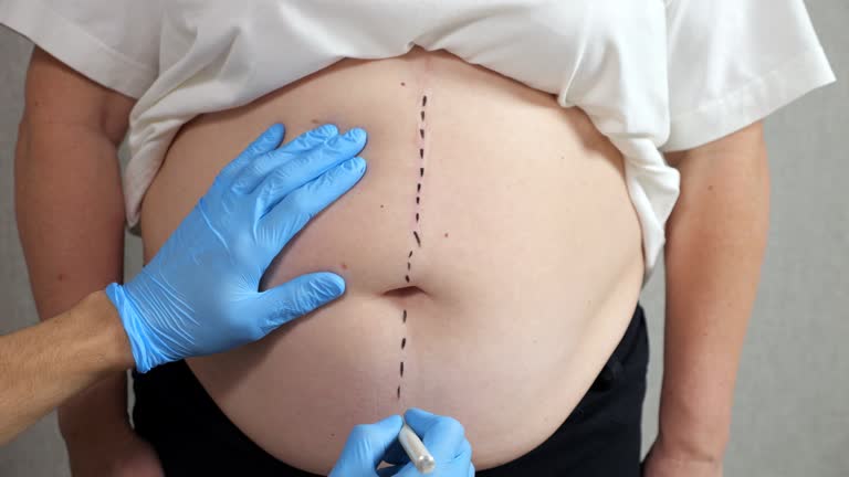 تجربتي مع عملية شفط الدهون في الرياض 2 ما هي عملية شفط الدهون؟