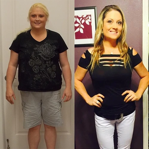 جراحة السمنة في الرياض 1 Obesity surgery 11zon