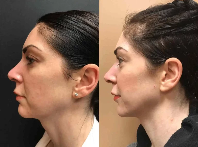 الالثيرا للوجه قبل وبعد