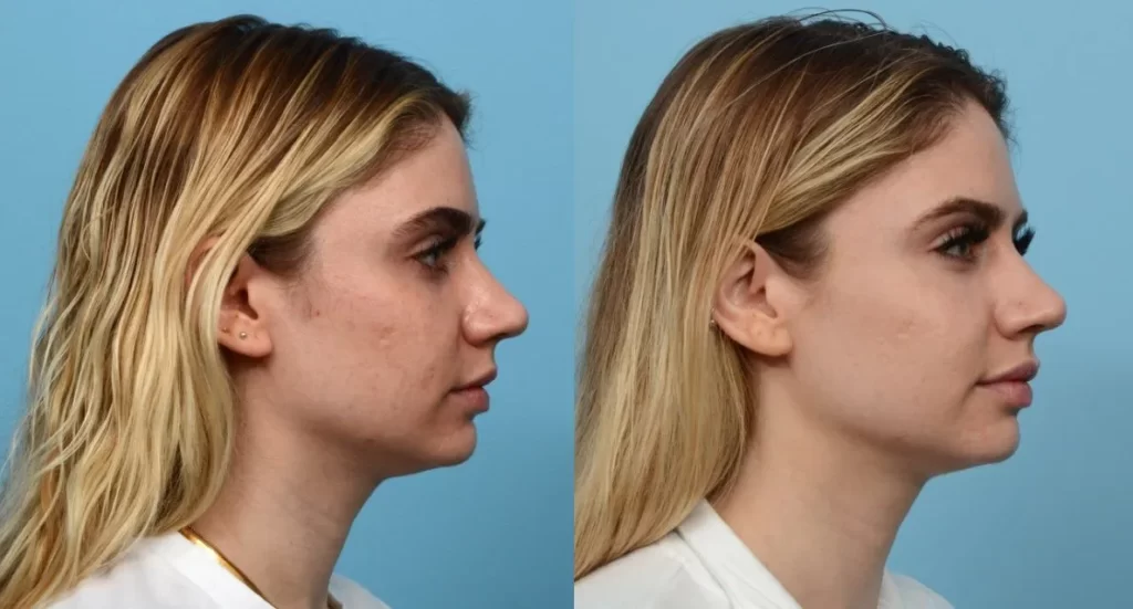 علاج مورفيوس 8 في الرياض 1 تقنية مورفيوس تجميل الوجه بدون جراحة