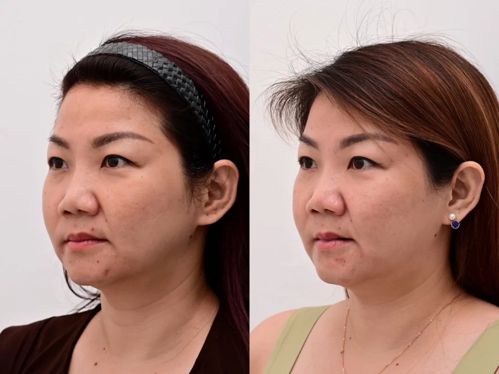 جهاز Ulthera لشد الوجه قبل وبعد في الرياض