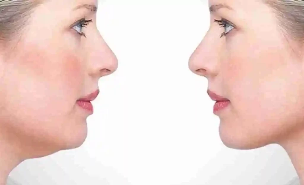 حقن الميزو للدهون قبل وبعد النتائج في الرياض