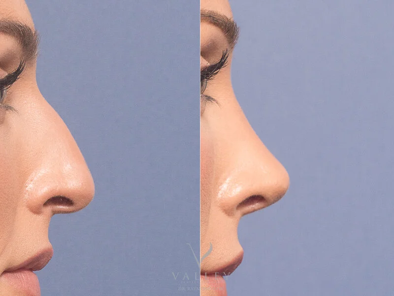فيلر الأنف في الرياض | تجميل الأنف بالفيلر 3 فيلر الأنف تجميل الأنف بالفيلر فيلر الأنف قبل وبعد 1