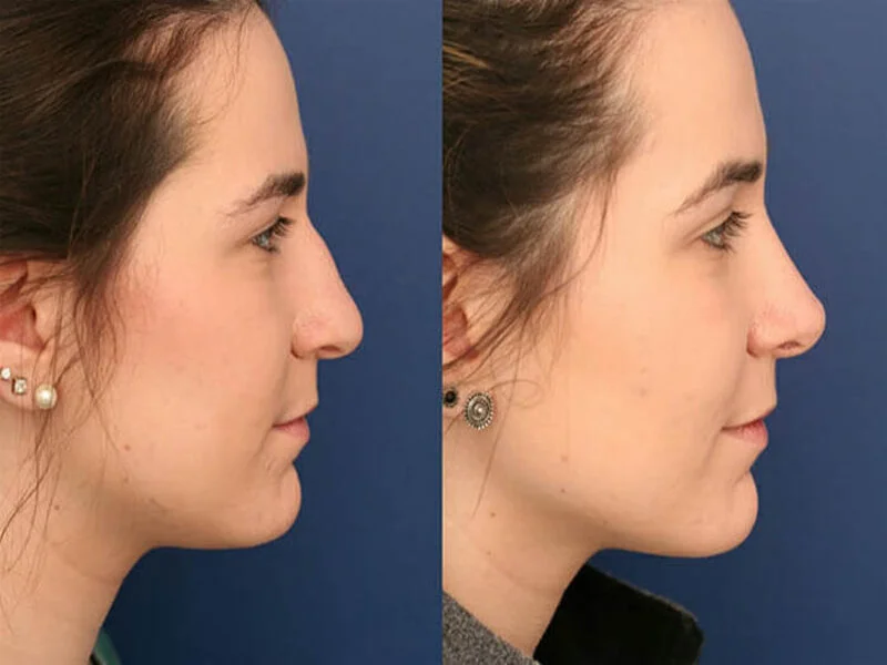 فيلر الأنف في الرياض | تجميل الأنف بالفيلر 1 فيلر الأنف تجميل الأنف بالفيلر فيلر الأنف قبل وبعد 2