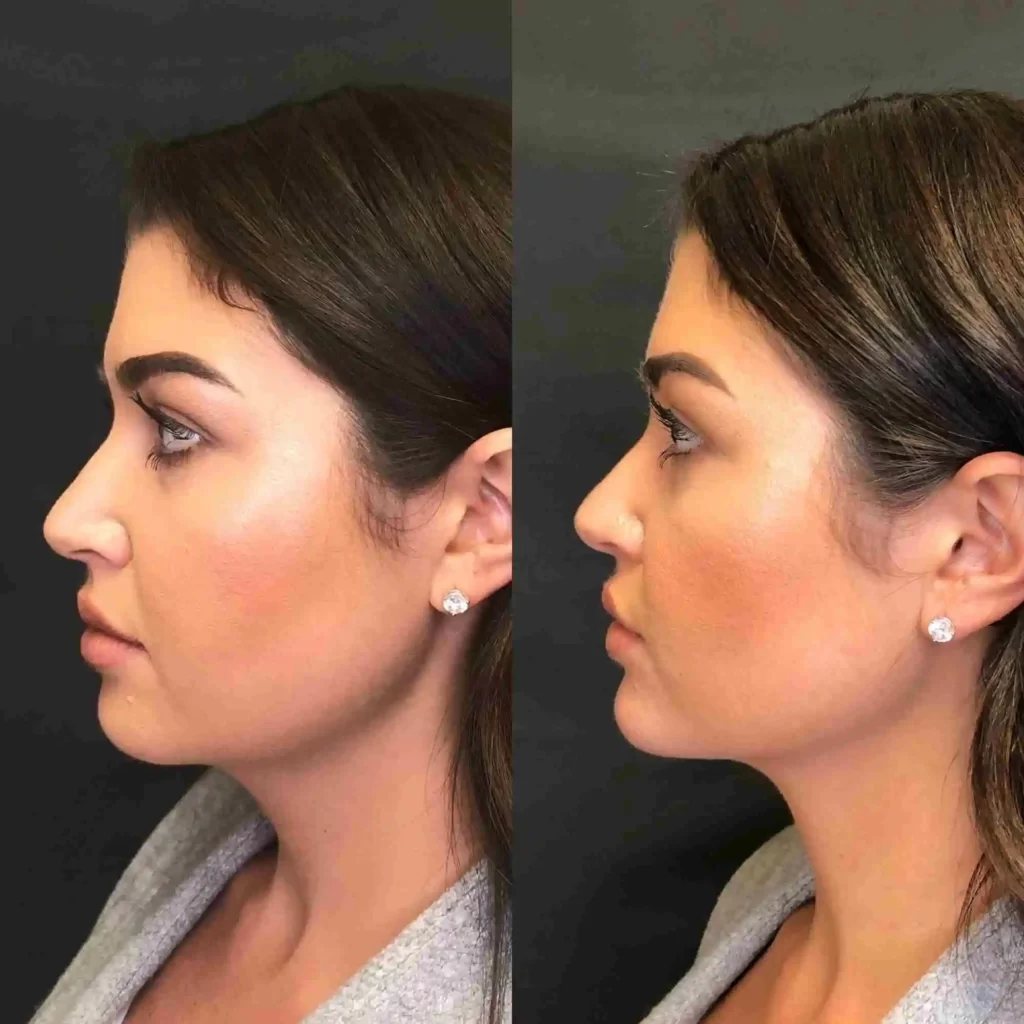 الخيوط الذهبية للتجميل قبل وبعد النتائج