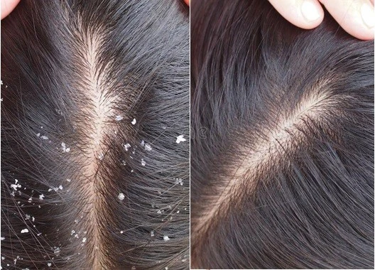 صدفية فروة الرأس (صدفية الشعر) قبل وبعد