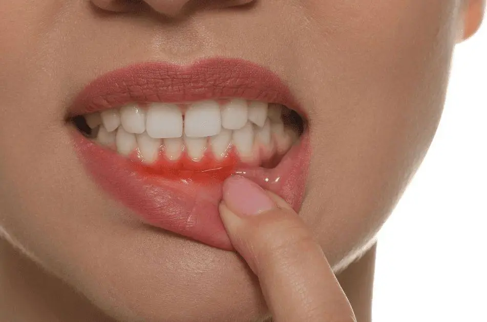 علاج انحسار اللثة في الرياض 3 تكلفة علاج انحسار اللثة في الرياض