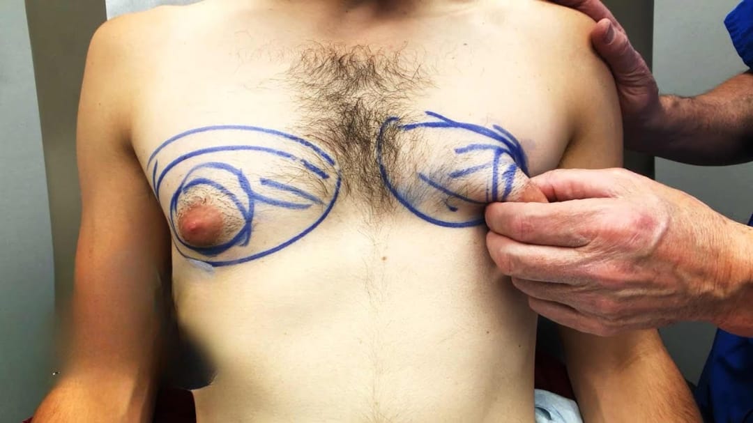 طرق تصغير الثدي عند الرجال (1)