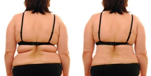عملية شد خط حمالة الصدر في الرياض 1 Bra line lift before after