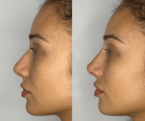 3بوتكس الأنف قبل وبعد