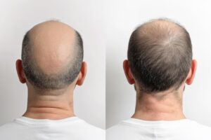 صوري قبل زراعة الشعر وبعدها