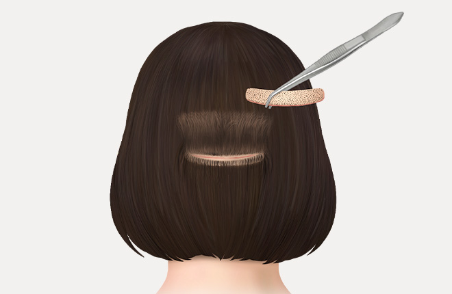 زراعة الشعر بالشريحة في الرياض 1 كيف تتم هذه العملية؟