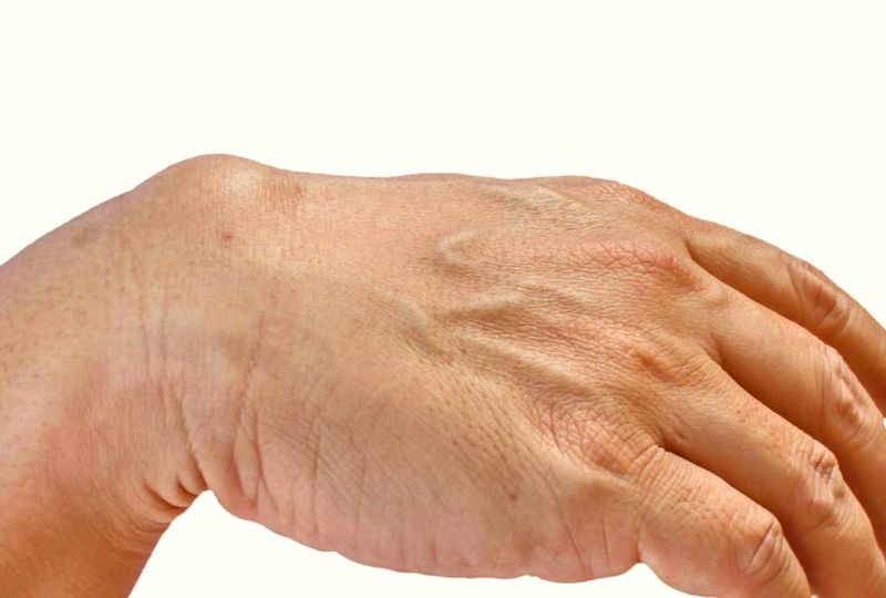 تكلفة علاج الكتل الجلدية في الرياض