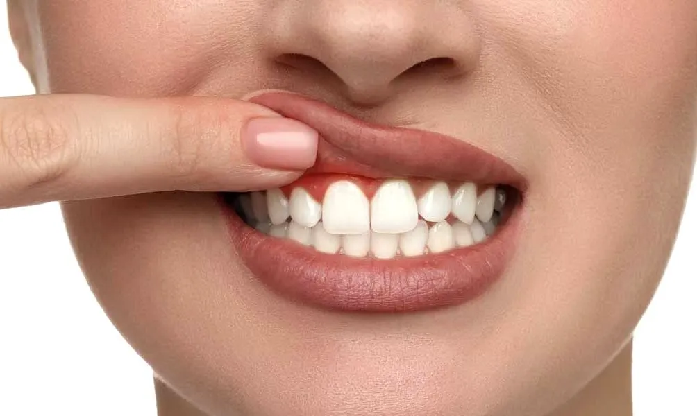 علاج أمراض اللثة في الرياض