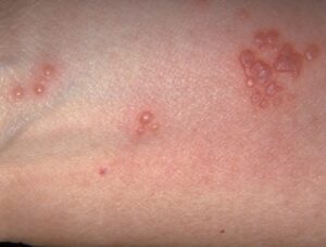 الحزام الناري في الرياض / جراحة رفع الحزام 4 شكل الحزام الناري في بدايته