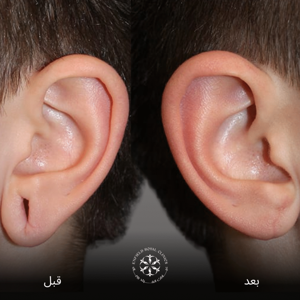 جراحة تجميل الأذن في الرياض 4 جراحة تجميل الأذن
