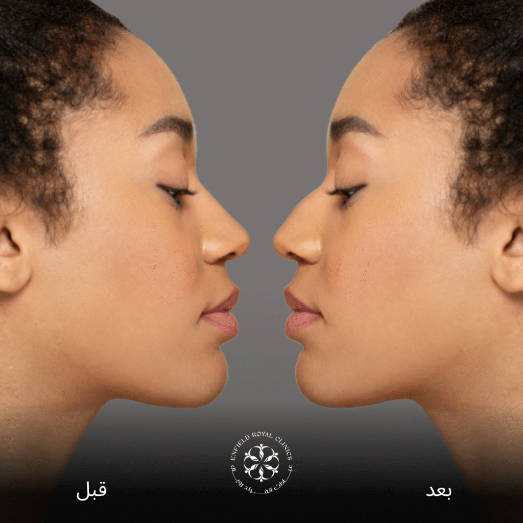 جراحة تجميل الانف في الرياض 2 جراحة تجميل الأنف في الرياض