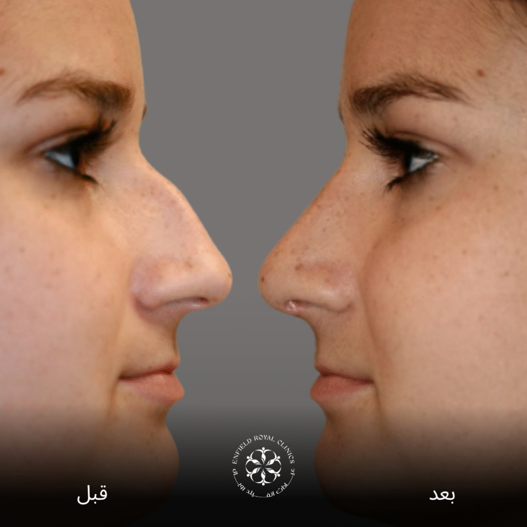 جراحة تجميل الانف في الرياض 3 جراحة تجميل الأنف ما قبل وما بعد