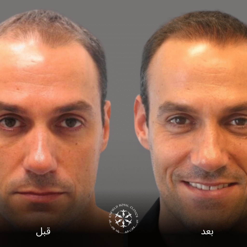زراعة الشعر في الرياض 1 زراعة الشعر