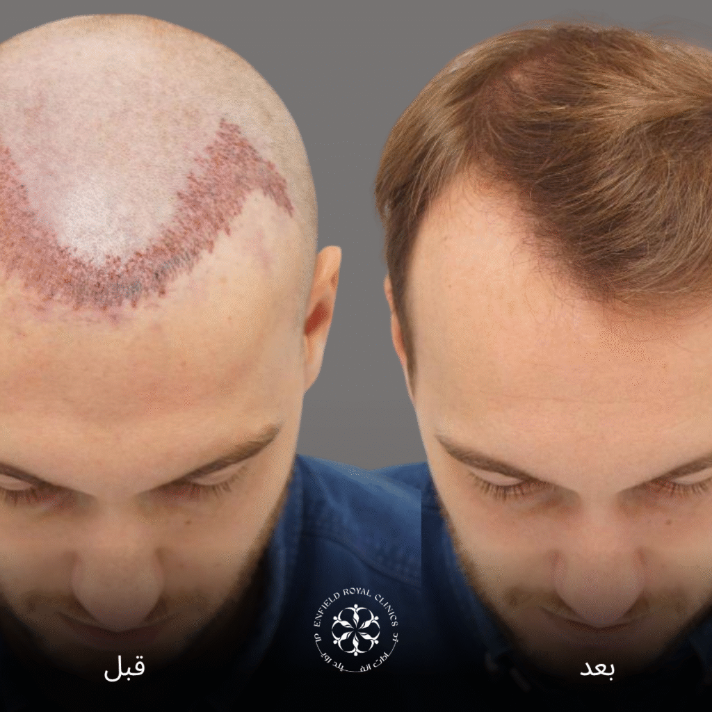 زراعة الشعر في الرياض 2 زراعة الشعر في الرياضa