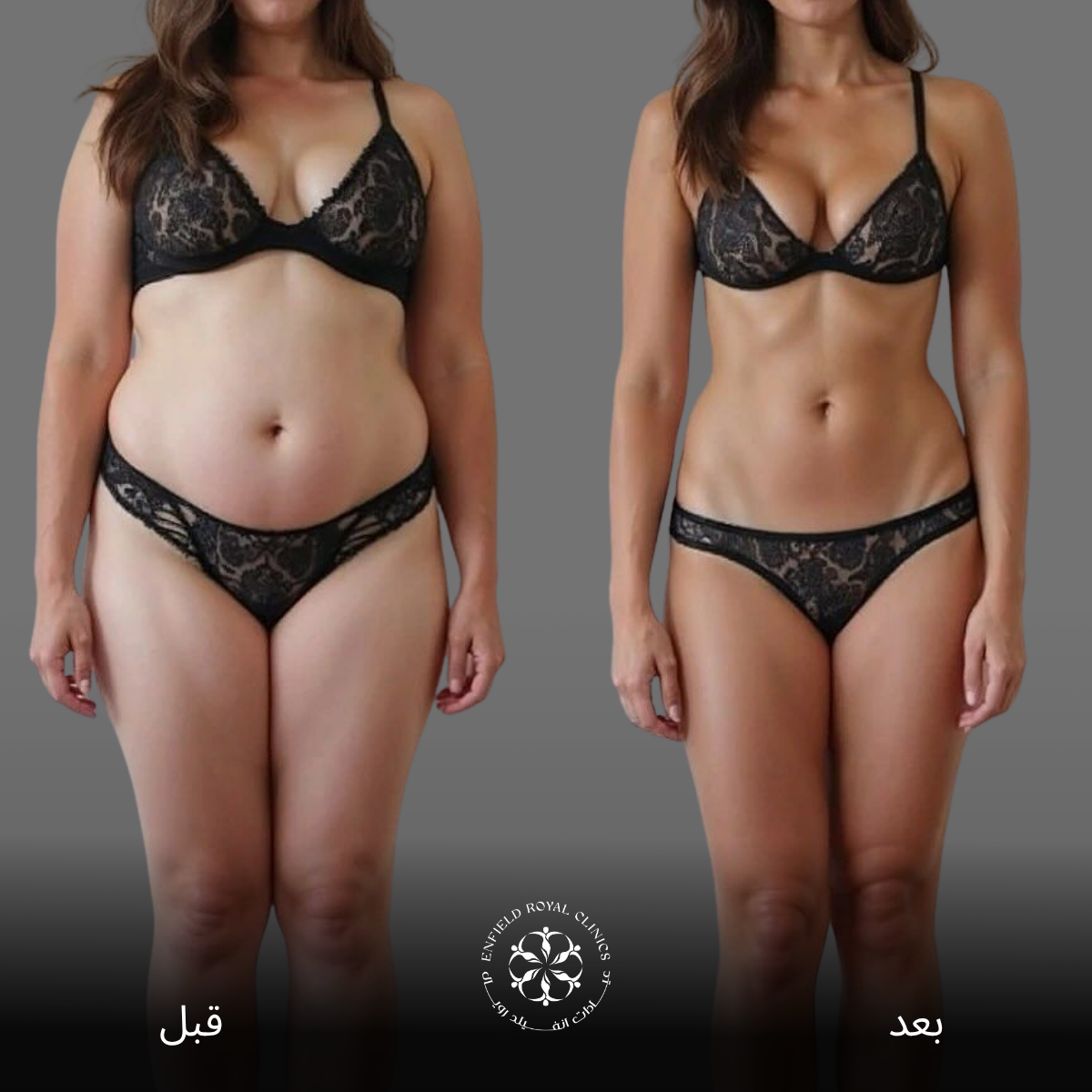 تجربتي مع عملية شفط الدهون في الرياض 12 شفط الدهون