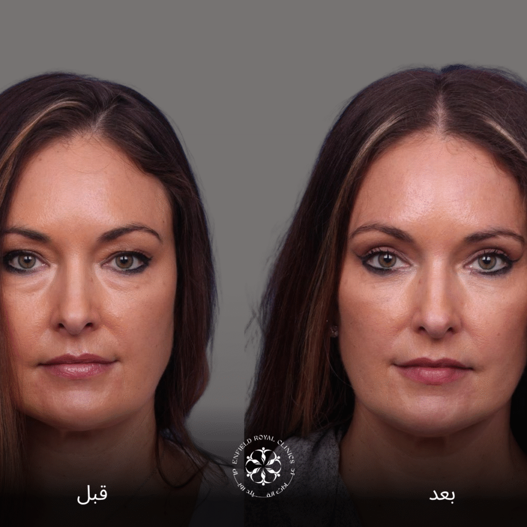 علاج ترهل الجفون