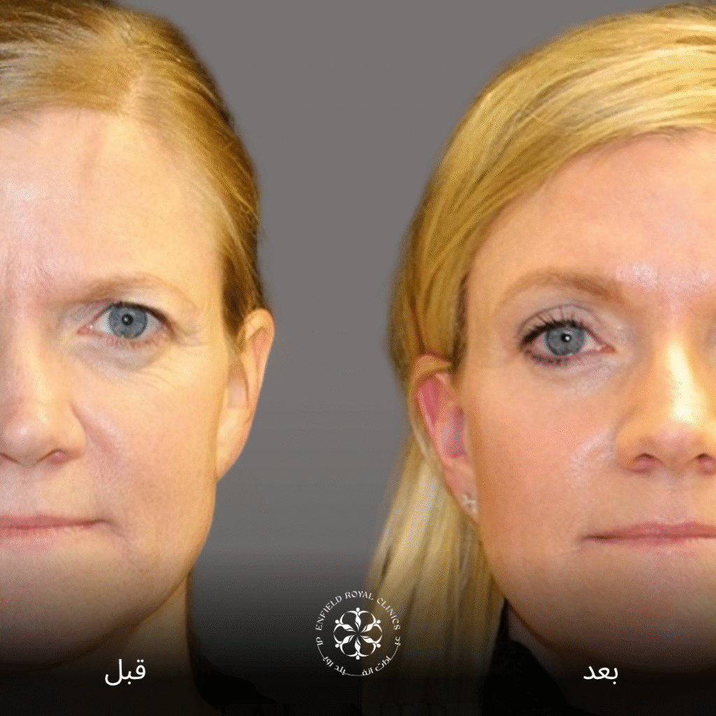 علاج ترهل الجفون في الرياض 2