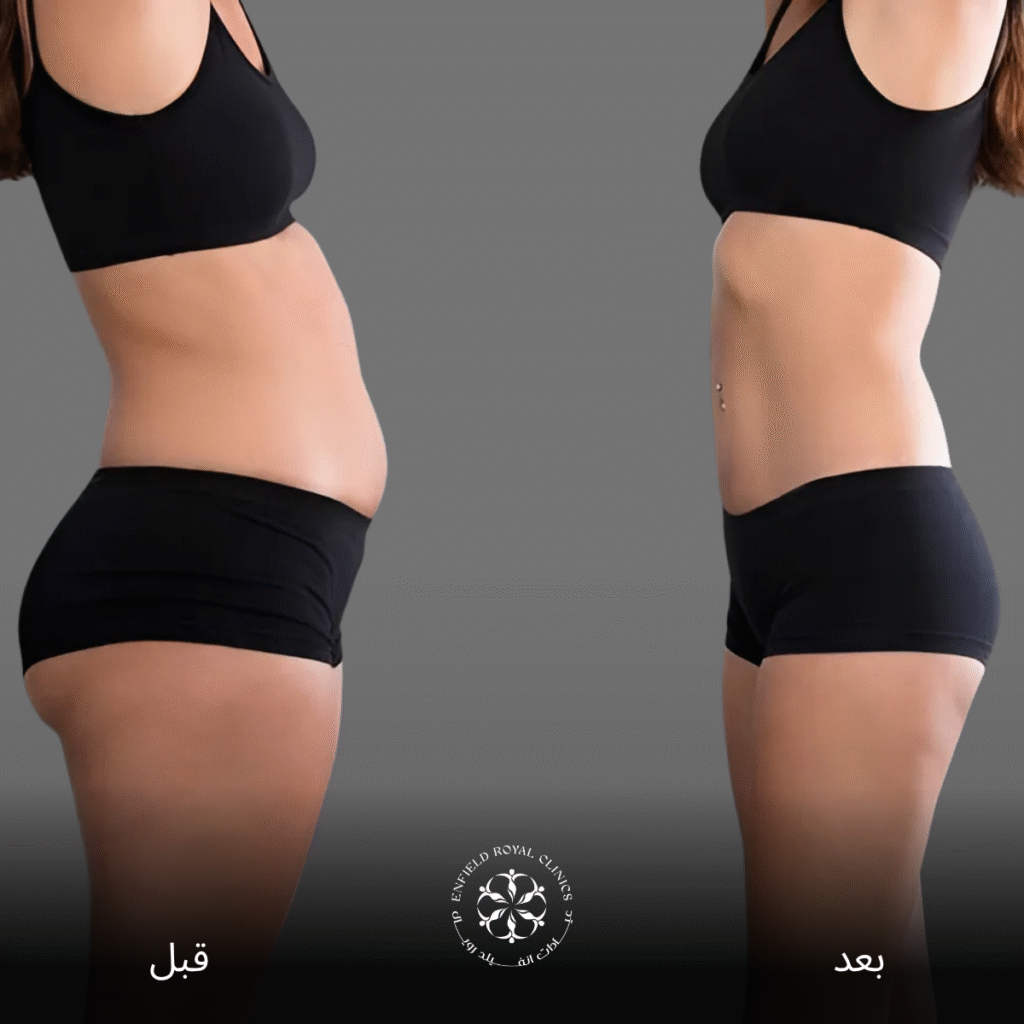 عملية شفط الدهون في الرياض