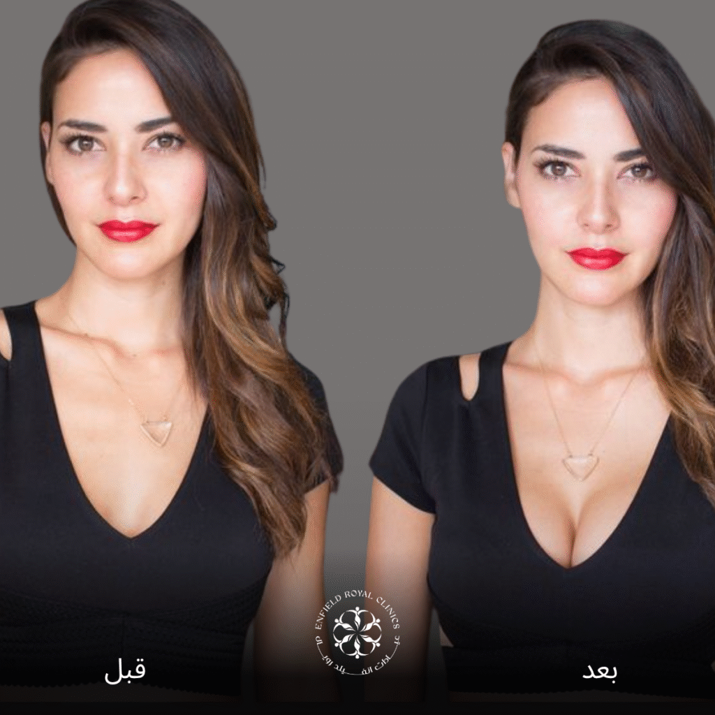 عملية تكبير الصدر في الرياض 1 تكبير الصدر