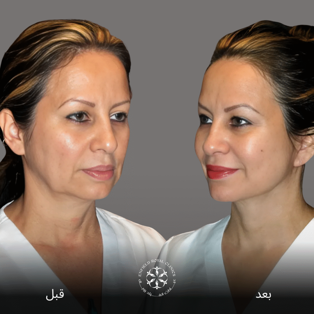 جراحة شد الوجه في الرياض 4 جراحة شد الوجه