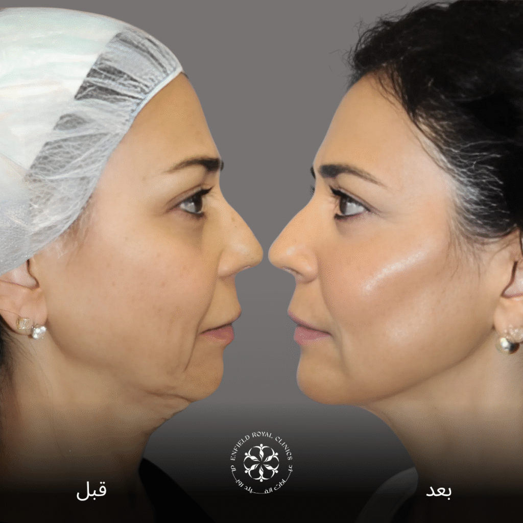 جراحة شد الوجه في الرياض 2 جراحة شد الوجه الرياض
