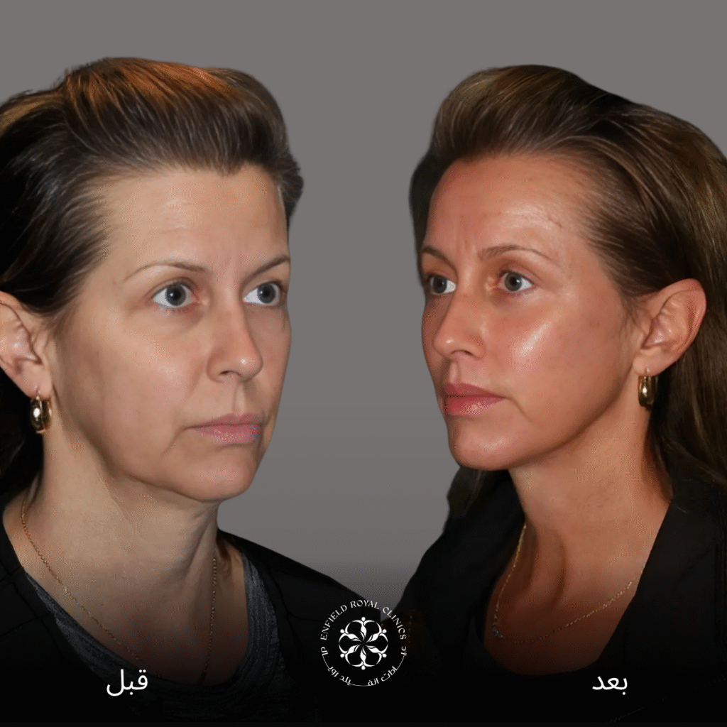 جراحة شد الوجه في الرياض 3 جراحة شد الوجه في الرياض