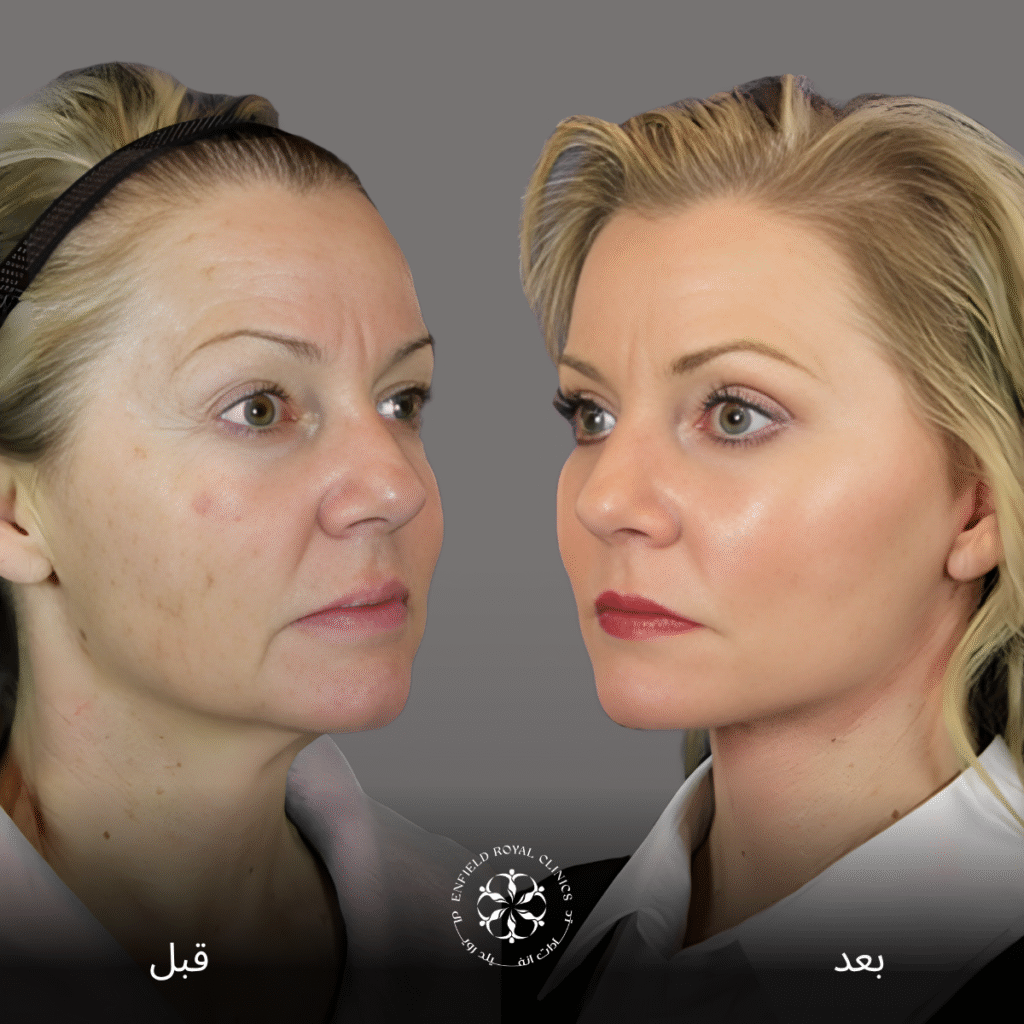 جراحة شد الوجه في الرياض 1 شد الوجه في الرياض