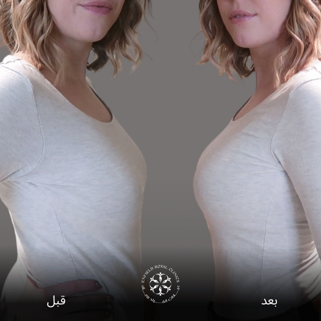 عملية تكبير الصدر في الرياض 2 عملية تكبير الصدر