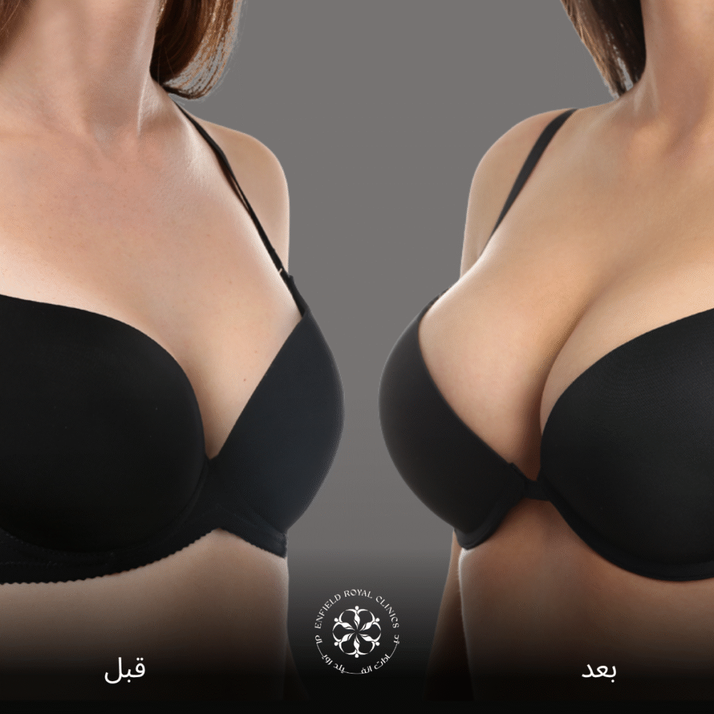 عملية تكبير الصدر في الرياض 4 عملية تكبير الصدر الرياض