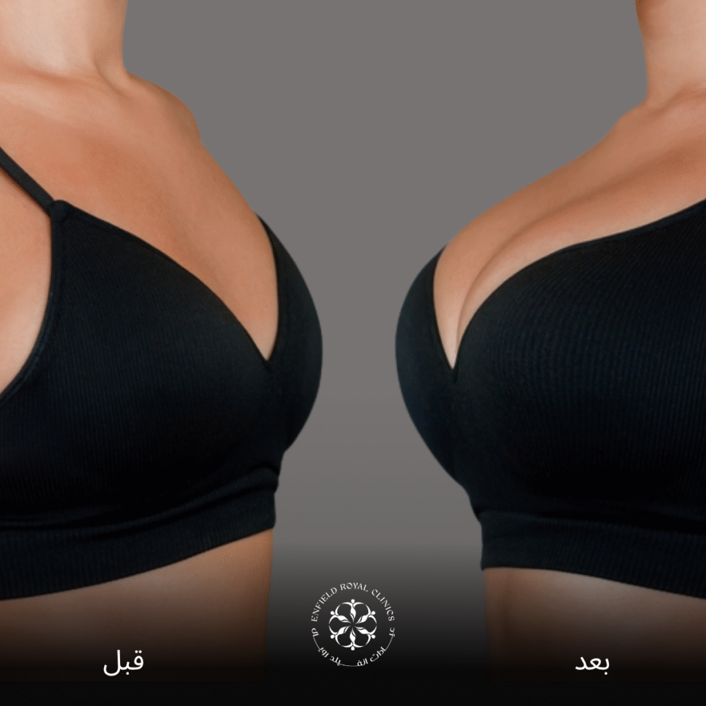 عملية تكبير الصدر في الرياض 3 عملية تكبير الصدر في الرياض