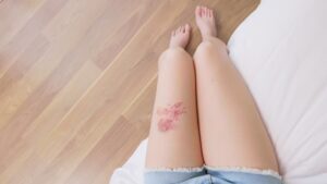 الحزام الناري في الرياض / جراحة رفع الحزام 5 الحزام الناري في الفخذ بالصور