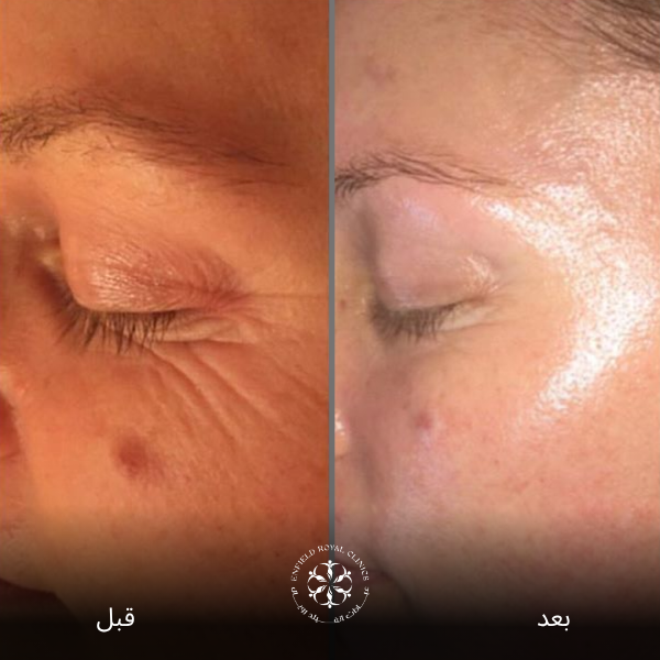 فينوس ليجاسي قبل وبعد