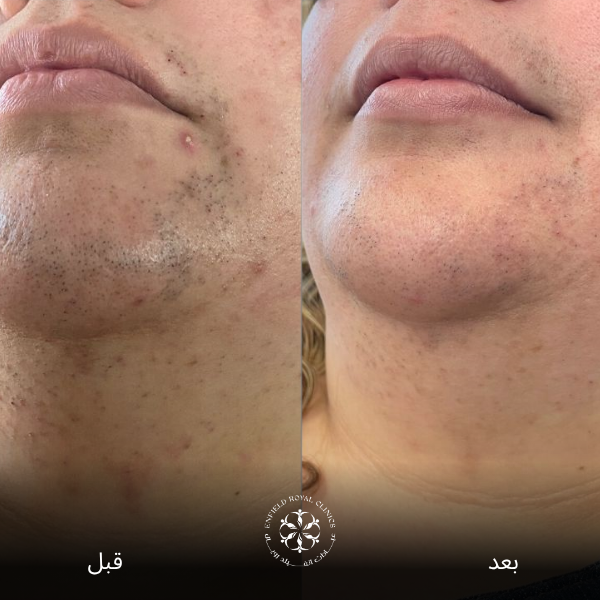 نتائج إزالة الشعر بالليزر قبل وبعد