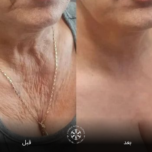 نتائج فينوس ليجاسي قبل وبعد