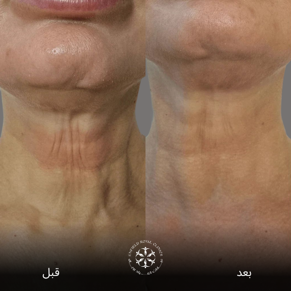 نتائج فينوس ليجاسي