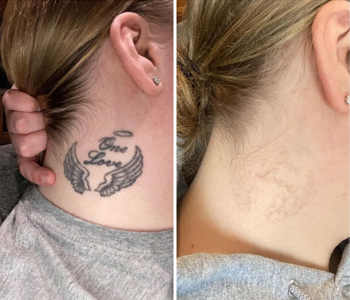 إزالة التاتو بالليزر قبل وبعد