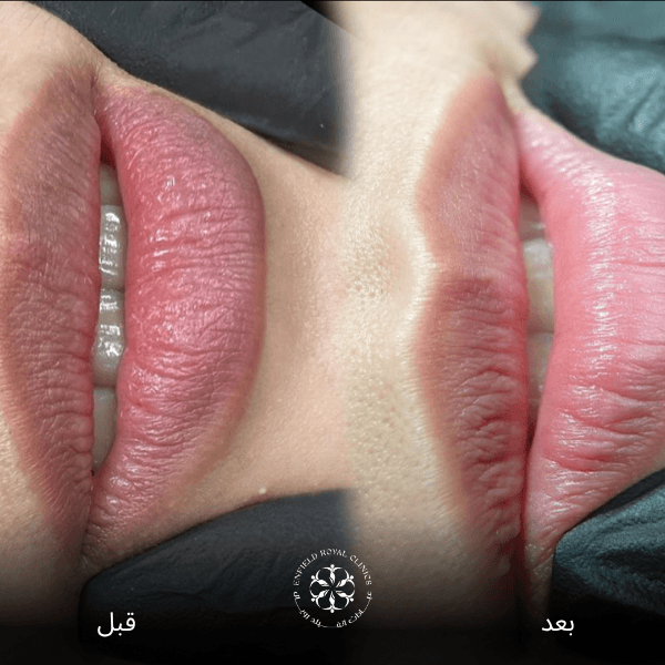 شفاه المدخن قبل وبعد2