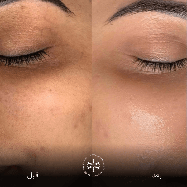 علاج الهالات السوداء في الرياض 2 علاج الهالات السوداء بالليزر قبل وبعد