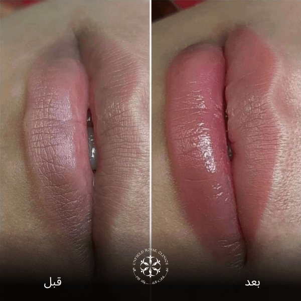 علاج شفاه المدخنين قبل وبعد