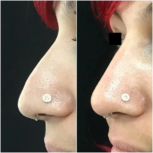 قبل وبعد عملية تجميل الأنف غير الجراحية