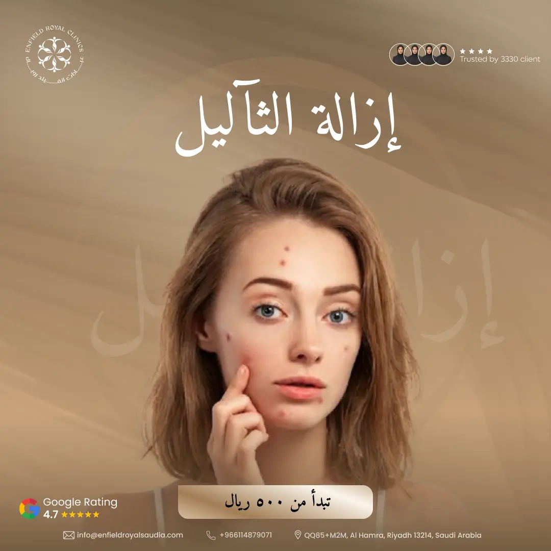 إزالة الثآليل (تبدأ من)